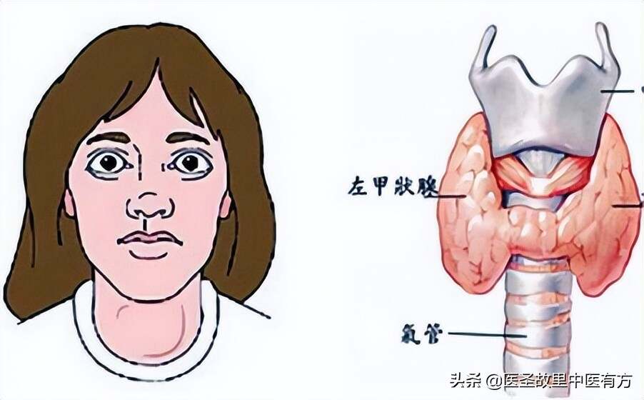 最新甲狀腺功能亢進(jìn)癥治療方法