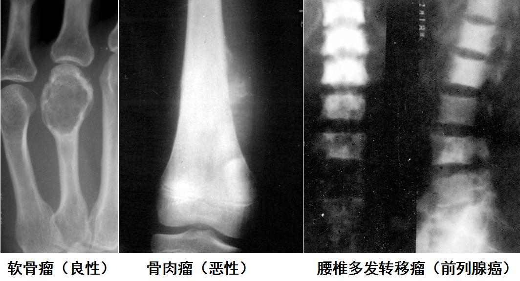 肺炎最新分析