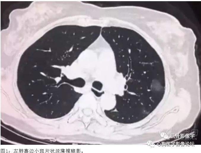 冠狀肺炎最新動態(tài)與最新進展??
